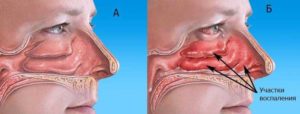 Болит носовая перегородка: причины и способы лечения заболеваний носа