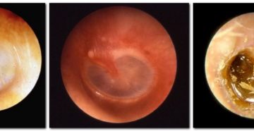 Признаки воспаления уха и эффективное лечение в домашних условиях