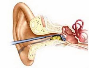 Как убрать серную пробку в домашних условиях и не повредить ухо?
