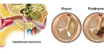 Разрыв барабанной перепонки: лечение и возможные осложнения