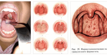 Как правильно лечить хронический атрофический фарингит?