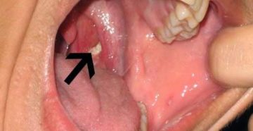 Неприятный запах из горла: основные причины симптома