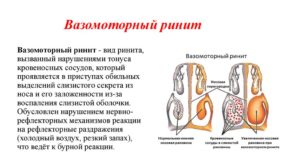 Как проявляется вазомоторный ринит и когда назначается операция?