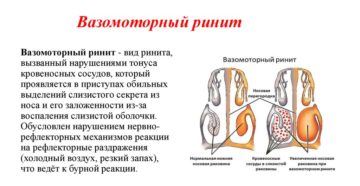 Как проявляется вазомоторный ринит и когда назначается операция?