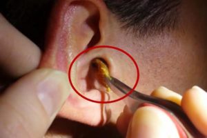 Ушная пробка: виды, симптомы и методы удаления