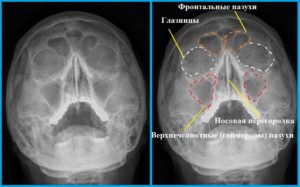 Рентгенография придаточных пазух носа: процедура и расшифровка снимка
