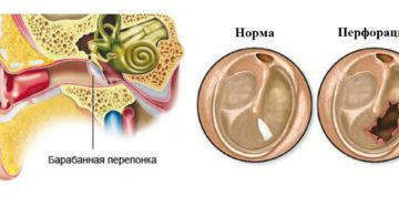 Перфорация барабанной перепонки: основные симптомы разрыва