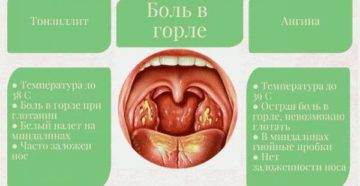 Болит горло, больно глотать, температуры нет причины и что делать?