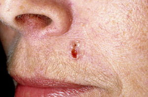 Базалиома на носу: основные симптомы и способы лечения опухоли