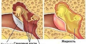 Симптомы и лечение тубоотита в домашних условиях