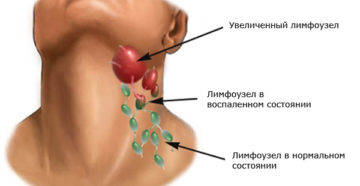 Что делать, если болит лимфоузел на шее слева?