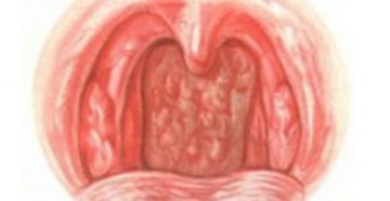 Гранулезный фарингит: основные симптомы недуга