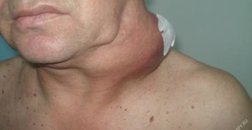 Рак лимфоузлов на шее: лечение и прогноз