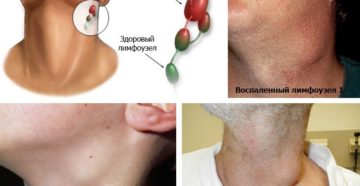 Воспаление подчелюстного лимфоузла: признаки и лечение