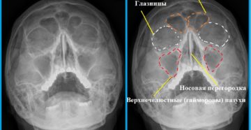 О чем может рассказать рентген носовых пазух?