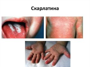 Скарлатина у детей: механизм заражения, лечение и профилактика заболевания