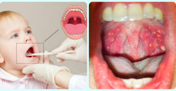 Как понять, что у ребенка болит горло? Первые признаки и способы их лечения