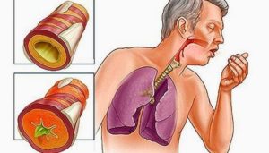 Что такое хронический бронхит, чем он опасен и как его лечить?