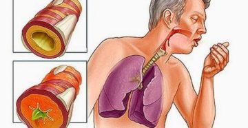 Что такое хронический бронхит, чем он опасен и как его лечить?