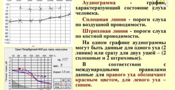 Что такое аудиометрия слуха и о чем она может рассказать?