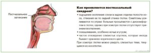 Синдром постназального затекания признаки заболевания, лечение и профилактика