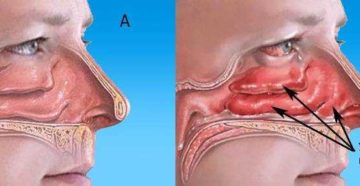Почему болит нос внутри и что делать?
