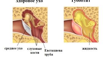 Острый тубоотит признаки и лечение недуга