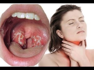 Что делать, если горло только начинает болеть?
