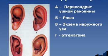 Воспаление ушной раковины: симптомы и лечение перихондрита