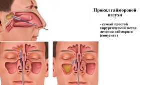 Прокол гайморовых пазух, лечение после прокола и возможные осложнения