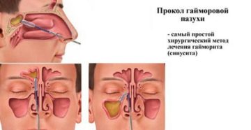 Прокол гайморовых пазух, лечение после прокола и возможные осложнения