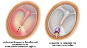 Шунтирование уха: показание, проведение и возможное осложнение