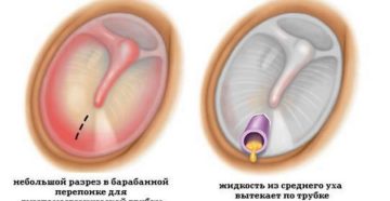 Шунтирование уха: показание, проведение и возможное осложнение