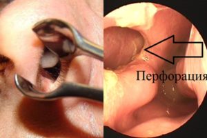 Почему возникает и чем опасна перфорация носовой перегородки?