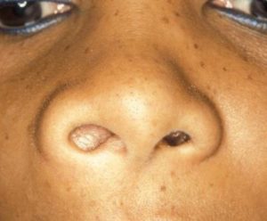 Киста в носу: симптоматика и способы лечения