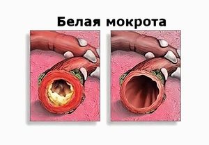 Белая мокрота