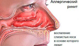 Аллергический ринит часть 1