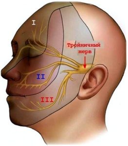 Невралгия тройничного нерва