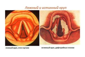 Круп/Острый стенозирующий ларинготрахеит