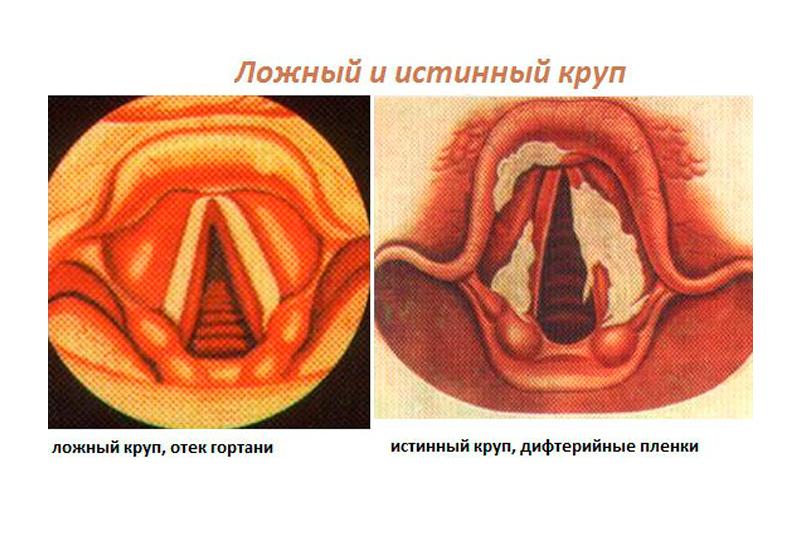 Стенозирующий ларингит презентация